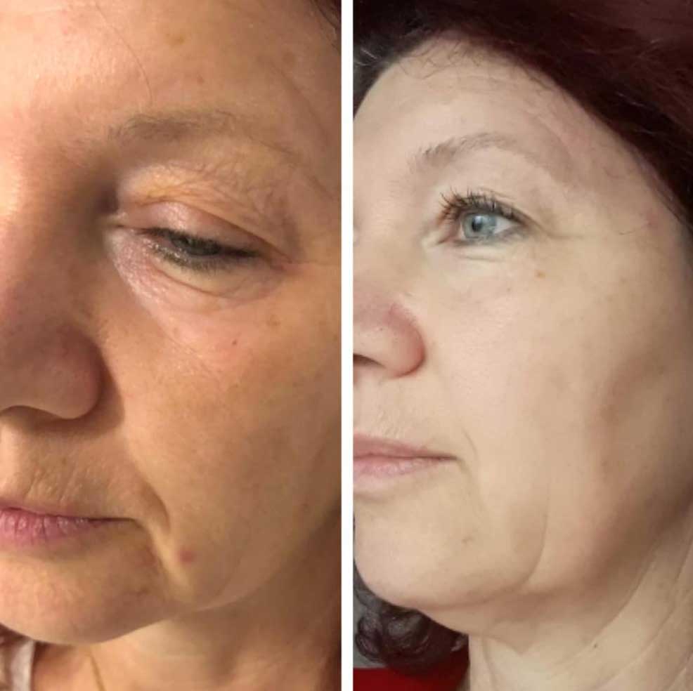 HIFU Lifting Nechirurgical - Facial și Corporal 18 BandA1