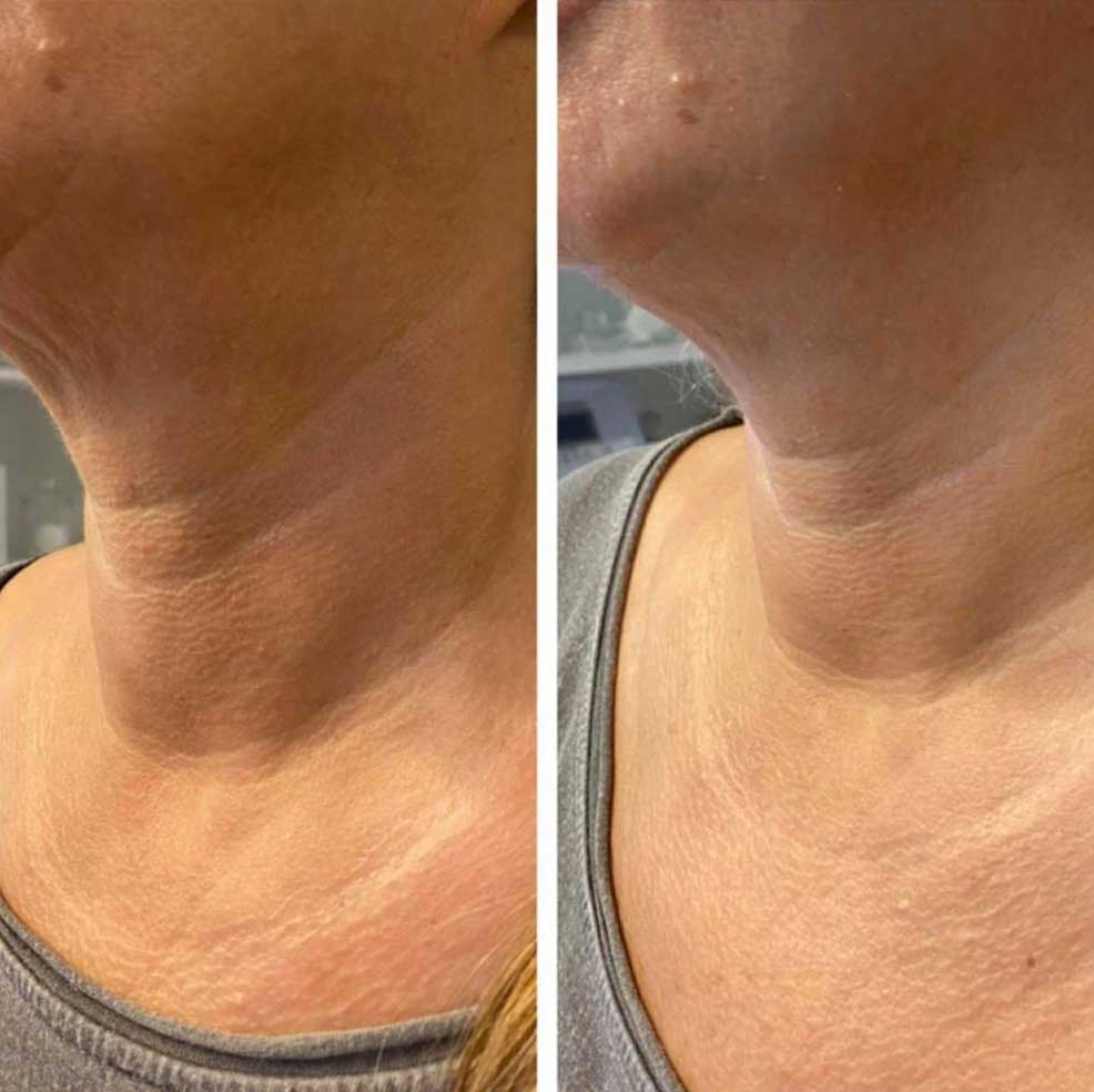 HIFU Lifting Nechirurgical - Facial și Corporal 17 BandA2