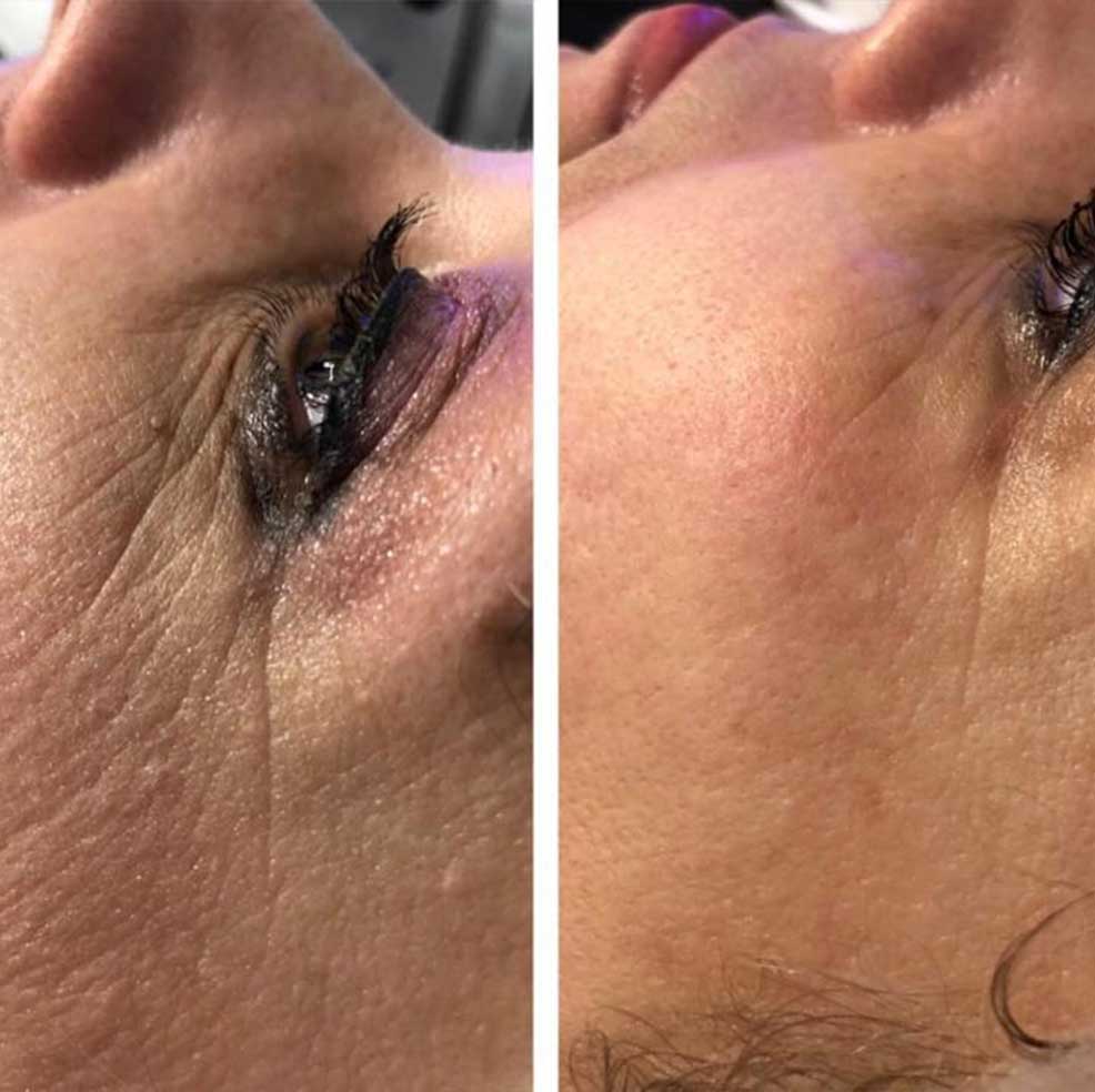 HIFU Lifting Nechirurgical - Facial și Corporal 16 BandA3