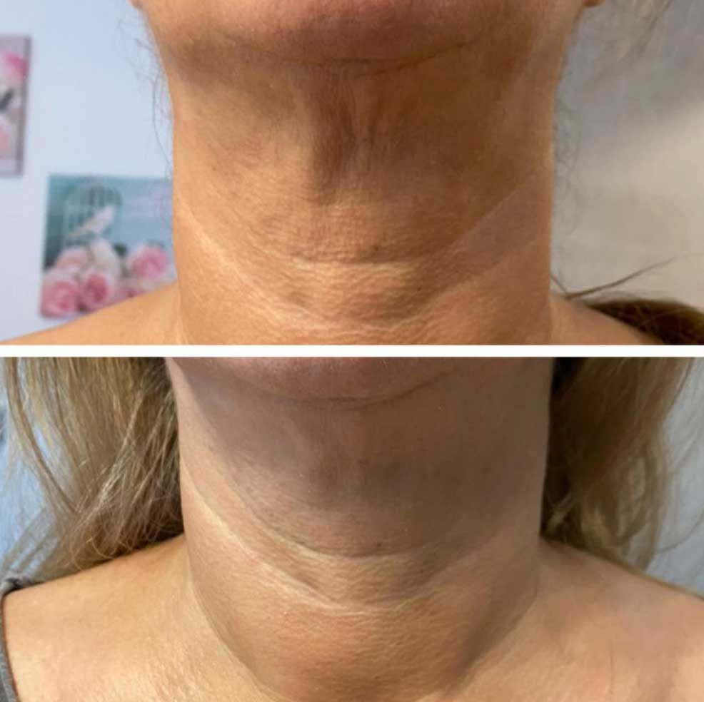 HIFU Lifting Nechirurgical - Facial și Corporal 15 BandA4