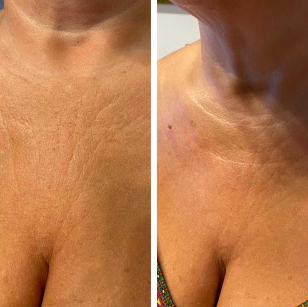 HIFU Lifting Nechirurgical - Facial și Corporal 14 BandA5