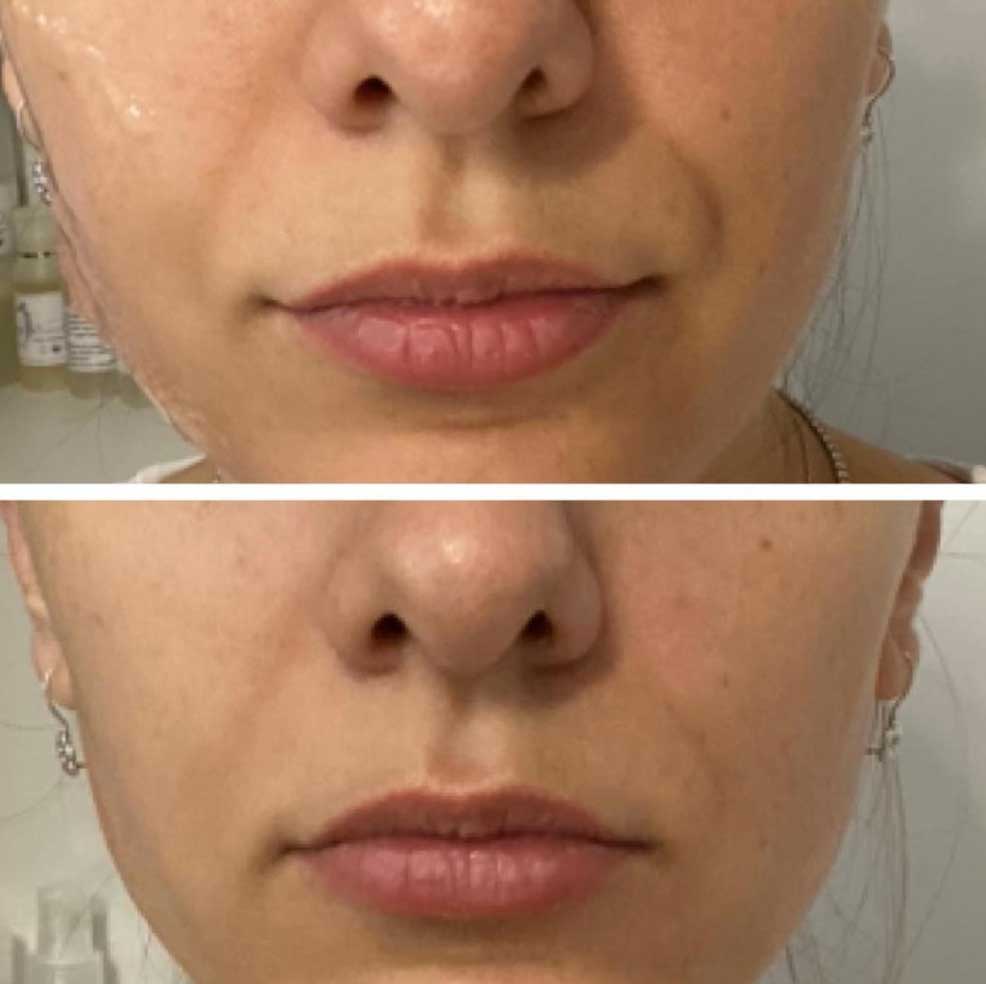 HIFU Lifting Nechirurgical - Facial și Corporal 13 BandA6