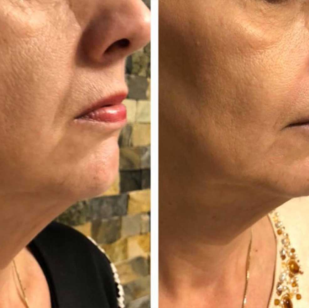 HIFU Lifting Nechirurgical - Facial și Corporal 12 BandA7